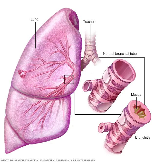 chronic_lung_disease